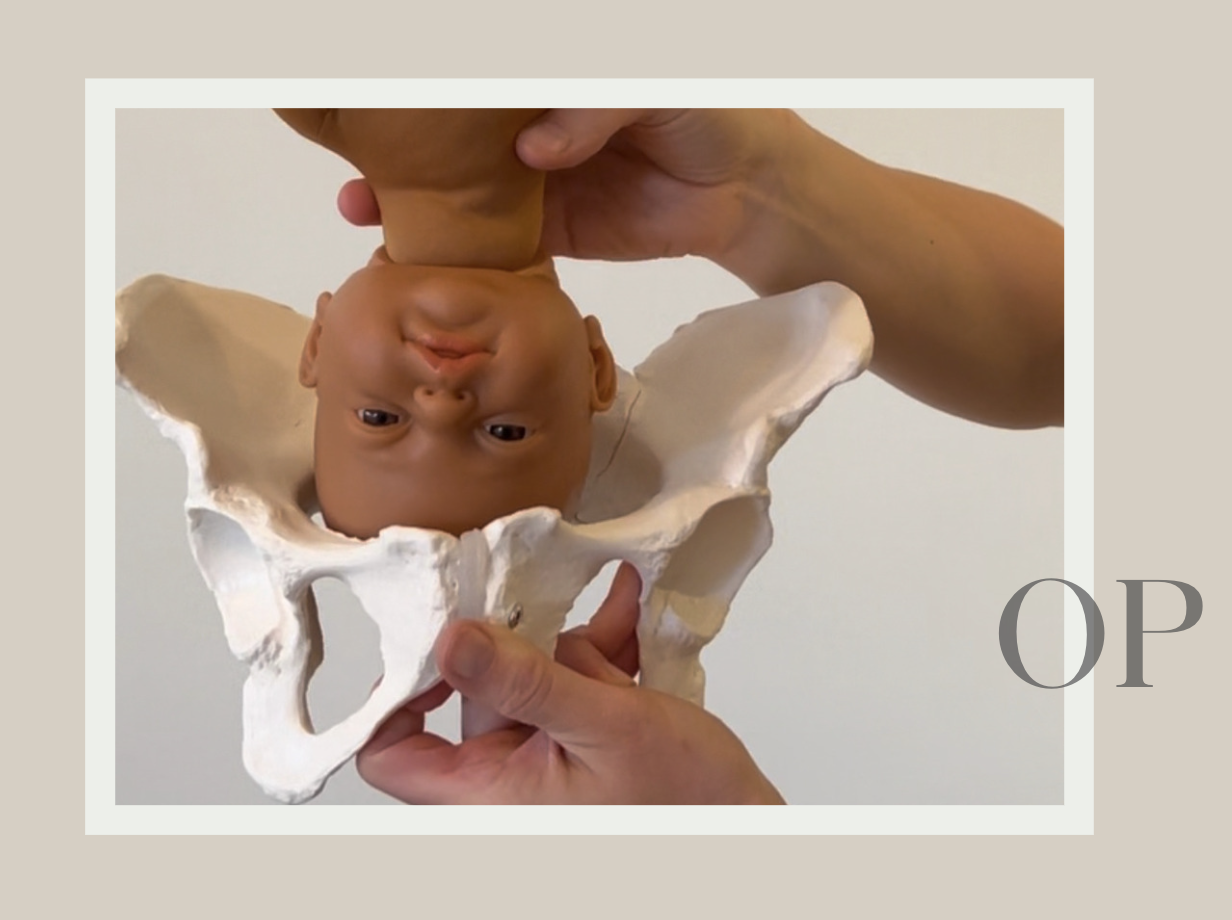 baby in occiput anterior position in pelvis